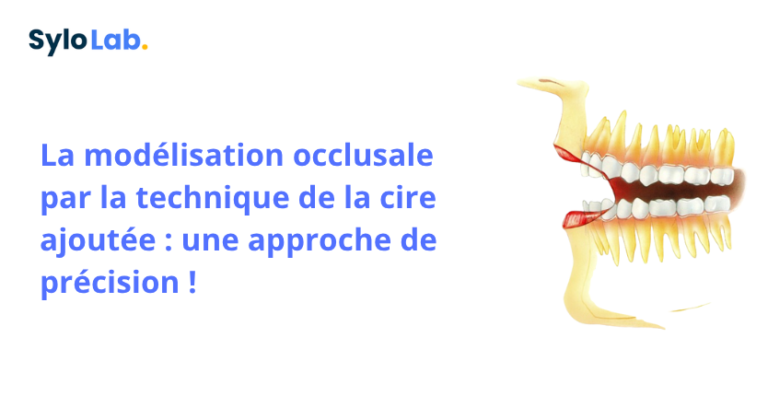 La modélisation occlusale par la technique de la cire ajoutée : une approche de précision