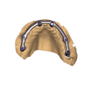 3D Dental Design All on 6