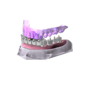 3D Dental Design Implant Bar