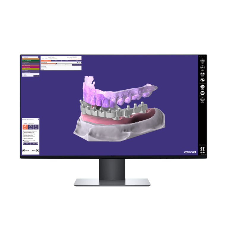 Conception 3D Barre Implantaire