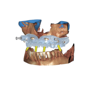 3D Design Surgical Guide