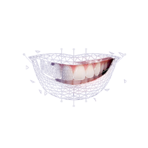3D Smile D design + Mock-up