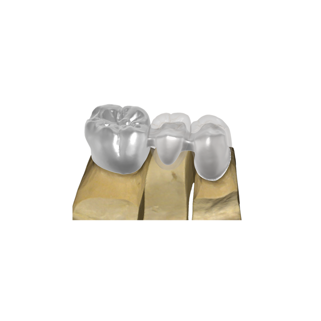 3D Dental Bridge Design