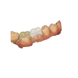 3D design – Inlay / Onlay / Overlay