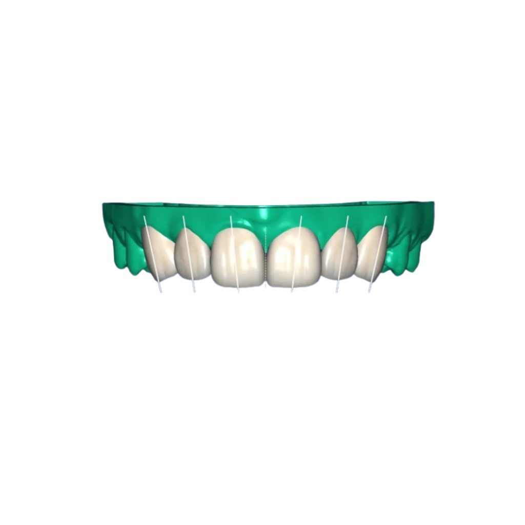 3D Design – Dental Veneers