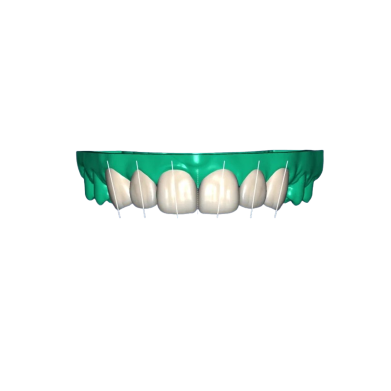 3D Design – Dental Veneers