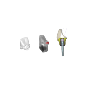 3D Dental Design – Inlay Core