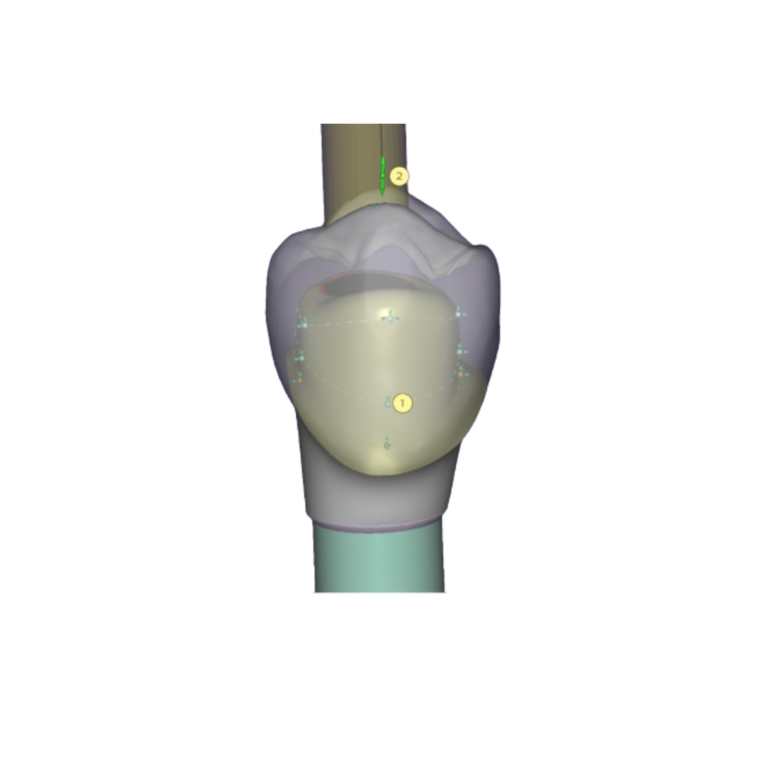 3D Dental Design Custom Pillar + Crown