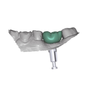 3D Dental Design of transvised crown